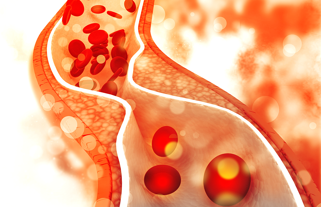動脈硬化で血管の壁が狭くなり血液の流れが悪くなっている画像