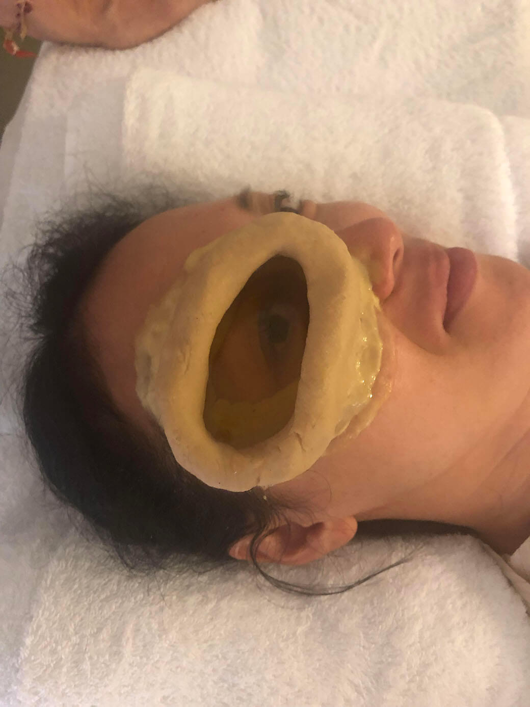 ネトラバスティという目の治療を受ける真理先生