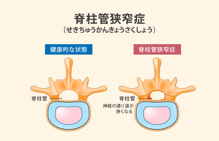 脊柱管狭窄症と健康的な背骨の比較