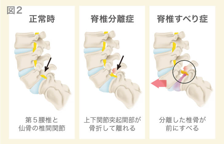 腰椎分離症と腰椎すべり症の解説