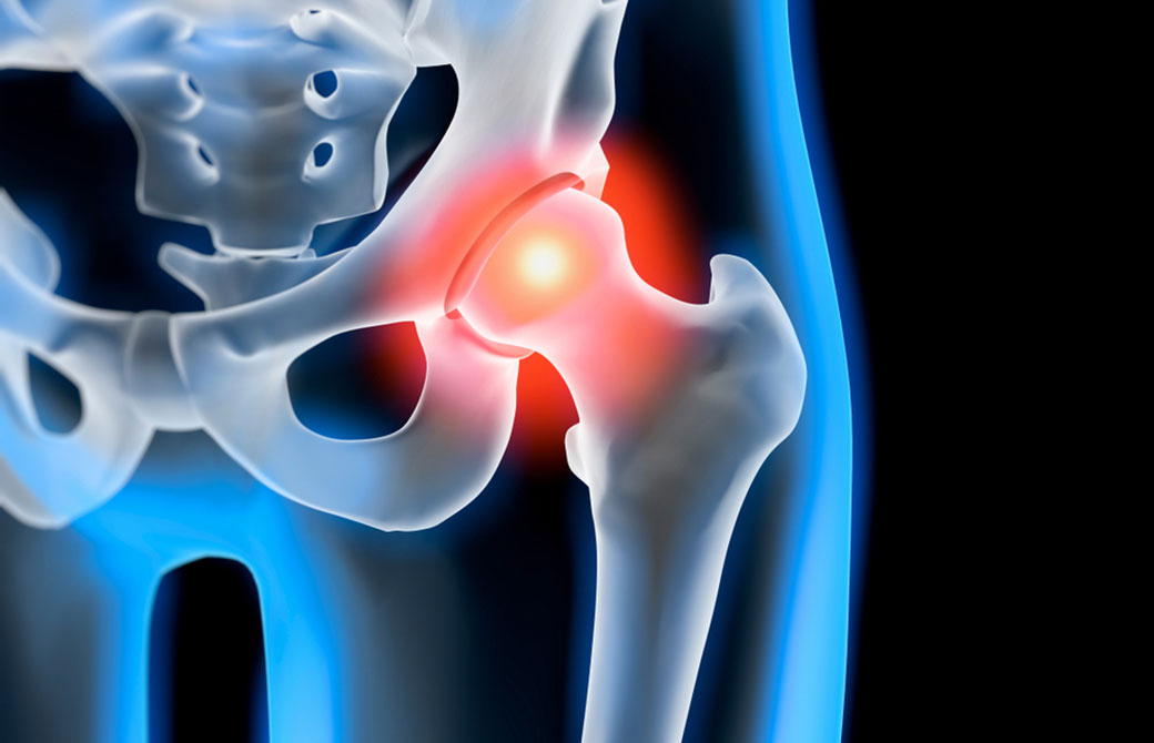 股関節の炎症