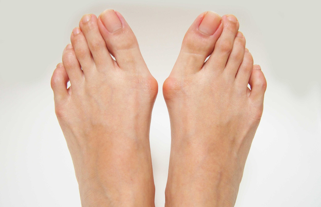 外反母趾の足の写真