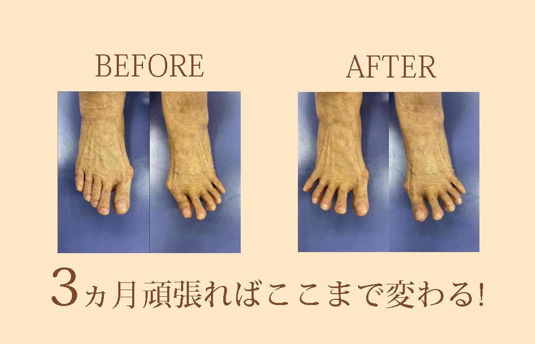 外反母趾の経過